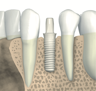 Metal Free Dental Implants