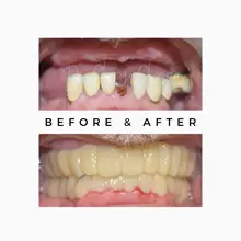 Before After 15
