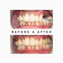 Before After 5