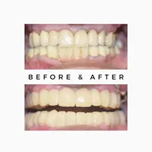 Before After 6
